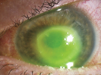 ochi infectat cu keratita amibiana