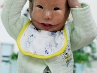 Caz extrem de rar! S-a nascut cu o masca din propria piele pe fata