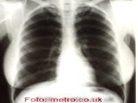 Radiografii pulmonare Marlyn Monroe