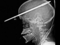 Radiografie sulita craniu