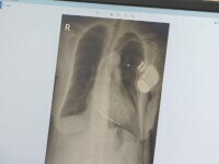 Premieră în România. Doi pacienți au primit câte un stimulator cardiac fără fir