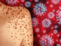 Infectarea cu variola maimuţei nu a cauzat niciun deces în Europa (oficiali din domeniul sănătăţii)