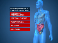 Operatie extrema, incheiata cu succes, in Romania. 9 chirurgi au operat un tanar ale carui organe erau invadate de cancer