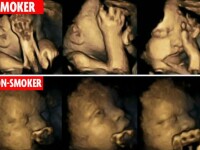 Imaginile dramatice care arata cum se comporta in pantece bebelusii mamelor fumatoare. Ce au stabili medicii