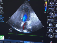 Consultația la medicul cardiolog, recomandarea medicilor după boala Covid-19. Ce presupune controlul