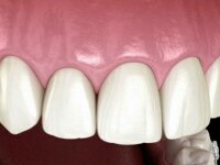 Cum funcționează aparatele dentare pentru adulți și la ce trebuie să fim atenți