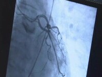 Intervenție complicată la Institutul CC Iliescu. Cateter și stent introdus prin vena femurală, inimă și artera pulmonară