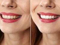 (P) Soluții moderne de albire dentară – Cum să obții un zâmbet strălucitor