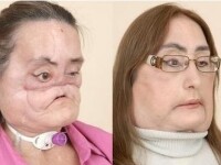 INCREDIBIL! Dupa transplantul de fata, spune ca s-a nascut a doua oara!