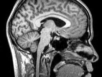tomografie creier