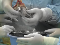 Organele unui tanar aflat in moarte cerebrala au salvat 5 vieti. Cum a decurs transplantul de inima la unul dintre pacienti