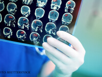 un medic examineaza o encefalograma