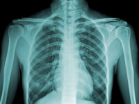 radiografie piept - Shutterstock