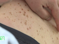 Primele semne ale cancerului de piele. Cum poate fi depistat la timp
