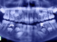 CSID. Care este cel mai eficient tratament pentru cariile apărute la dinții de lapte