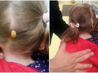 Ce i-a apărut unei fetițe în spatele capului, după ce s-a jucat într-un parc din Suceava