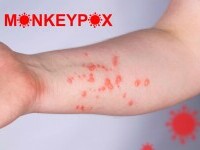 Al doilea caz de variola maimuței, diagnosticat în România