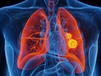 cancer pulmonar