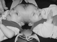 Fascinant! Povestea siamezelor care au acelasi creier, ganduri si simturi