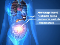 Eleva de 14 ani, cu hemoragie interna, dupa ce a fost batuta de un coleg la scoala. Fata a fost transferata in Capitala