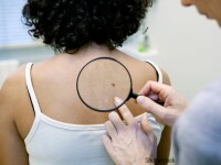Cancerul de piele, un pericol în perioada verii. Cum recunoști simptomele și cum îl previi