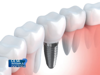 Puteti face o investigatie RMN chiar daca aveti implanturi dentare. Care sunt riscurile de pierdere a unui dinte pus astfel