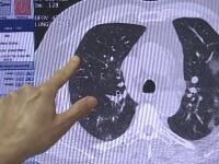 Ce este adenocarcinomul pulmonar. Investigația anuală care poate depista cancerul la plămâni într-o fază incipientă