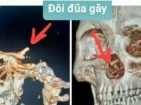 Descoperire surprinzătoare în craniul unui bărbat, care s-a prezentat cu dureri atroce la spital. Ce pățise la beție