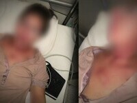 Femeie intoxicata cu mercur