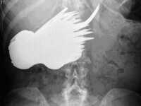 SOC la radiografie! A inghitit 78 de linguri si furculite!