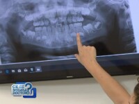 radiografie dinti