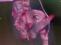 Reușită medicală, la Iași, după o operație de 20 de ore. Cum s-a schimbat viața unei fetițe