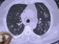 Fibroza pulmonară ireversibilă, marele pericol după Covid. Iată ce investigații trebuie să faci pentru a o evita