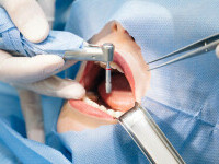 dentist operatie