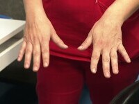 Spitalele impun reguli mai dure. Doctorițele și asistentele nu mai au voie cu unghii lungi, date cu ojă, și cu inele