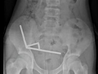 Un băiat de 13 ani a fost operat de urgență după ce a înghițit peste 100 de magneți. Ce le-a dezvăluit medicilor. FOTO