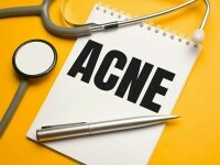 (P) Acnee: Top 3 greșeli care-ți afectează tenul cu tendință acneică
