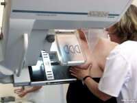 mamografie
