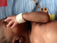 Un bebelus nascut cu patru maini si patru picioare, operat cu succes pentru a i se inlatura 