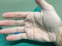 Cum arată mâna unui chirurg român după 12 ore de operații la 30 de grade
