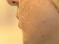 Cum pot fi evitate cicatricele provocate de acnee