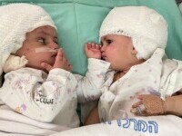 Două fete gemene siameze au fost separate în urma unei operații extrem de rară în Israel