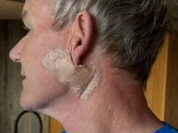 Gordon Ramsay a fost operat pentru cancer de piele. „Vă rog să nu uitaţi să vă daţi cu cremă de protecţie solară”