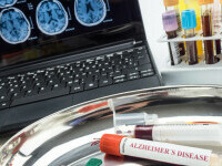Un nou test de sânge ar putea revoluționa diagnosticarea Alzheimer. Studiul implică peste 1.000 de pacienți