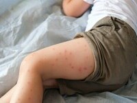 Cel puțin 49 de cazuri de rujeolă au fost înregistrate în septembrie. Vaccinările ROR continuă în întreaga țară