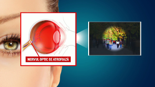 controlul vederii în glaucom