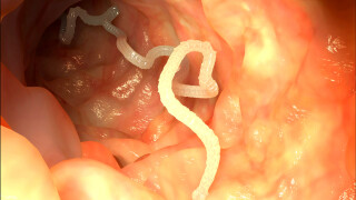 ce sunt condiloamele pe colul uterin