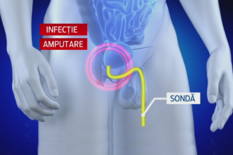amputarea parțială a penisului