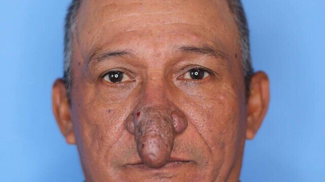 FOTO Transformarea incredibilă a unui bărbat căruia nasul i-a crescut exagerat de mult: „Îmi ajungea la buze” - Imaginea 10
