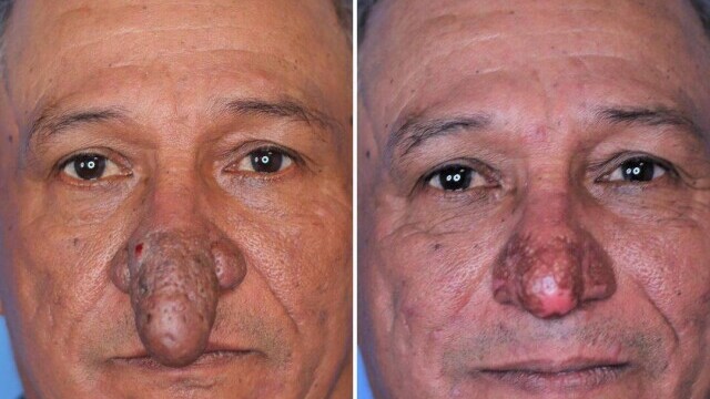 FOTO Transformarea incredibilă a unui bărbat căruia nasul i-a crescut exagerat de mult: „Îmi ajungea la buze” - Imaginea 9